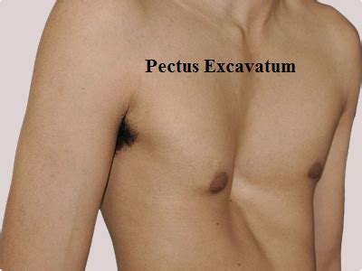 People with pectus carinatum usually develop normal hearts and lungs. Cheat wall deformity