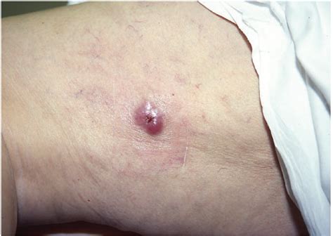 Rather, they can look innocuous, even like a bug bite. Merkel Cell Cancer : Merkel Cell Carcinoma Wikipedia / It ...