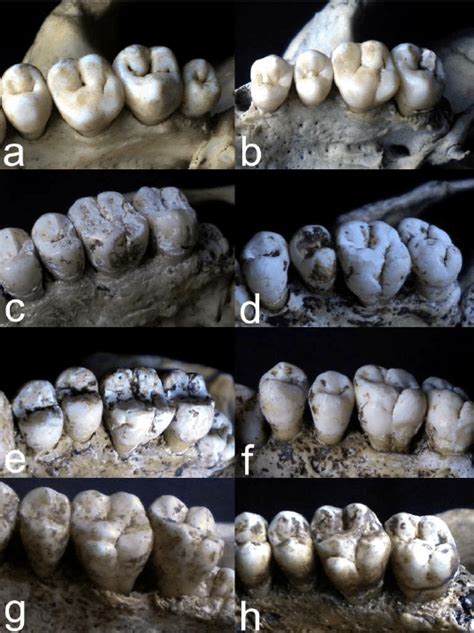 This extra cusp is usually found on the second molar, and becomes progressively less likely in the first, third molars. Different expressions of Carabelli's trait, according to ...