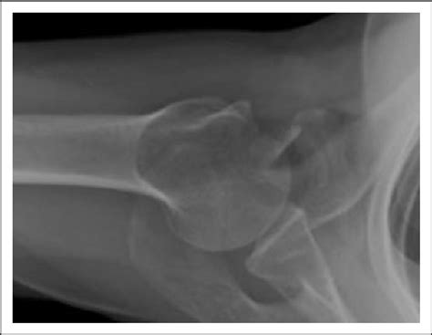 What is meant by image quality. Axillary shoulder X-ray demonstrating a displaced fracture ...