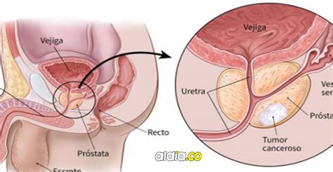 Maybe you would like to learn more about one of these? El cáncer de próstata es el más común en los hombres | AL DíA