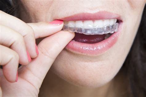 Maybe you would like to learn more about one of these? How To Get Pearly White Teeth With Braces - TeethWalls