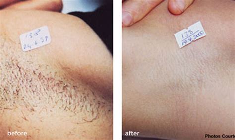 Dark spot laser removal before and after. Laser Hair Removal Treatments Before & After Photos