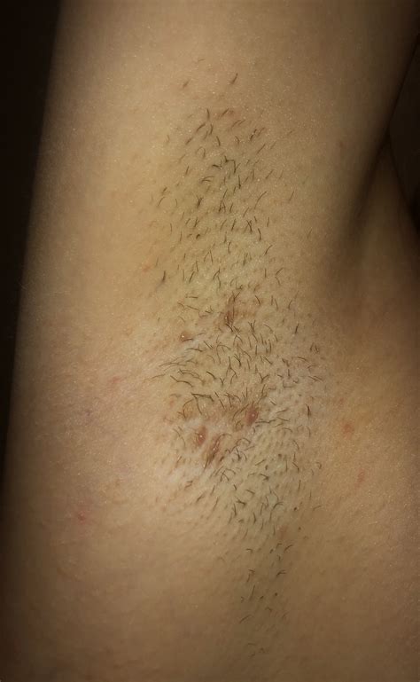 Wenn die wand eines blutgefäßes beschädigt ist, bildet das blut einen klumpen bei einer phlebographie, wird ein kontrastmittel in eine kleine vene an deiner hand oder deinem fuß gespritzt. Dauerhaft Pickel unter der Achsel? (Hautprobleme)