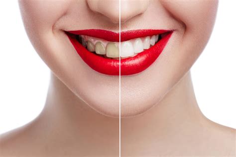 Or is there a way dentists can paint over your healthy teeth and maybe lighten them a. Dental Veneers FAQs - Park 56 Dental