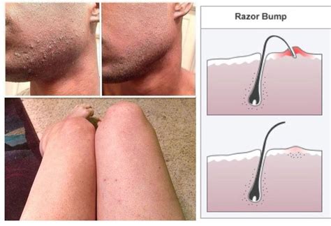 Shaving without one of these can and will cause razor burn. 10 Ways To Get Rid Of Your Razor Bumps And Skin ...