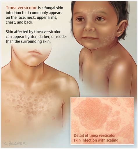 An overgrowth of a certain type of yeast, known as pityriasis versicolor, on the skin can cause a common skin condition known as tinea versicolor. Tinea Versicolor. | Dermatology | JAMA | JAMA Network