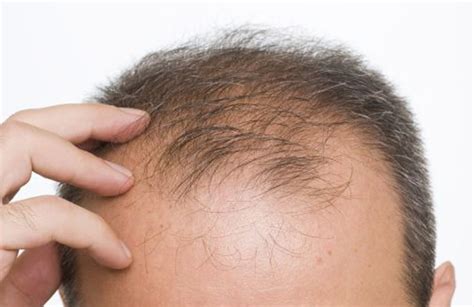 Oct 14, 2019 · estas son las razones por las que se te cae el pelo, según los médicos desde cambios en la dieta a enfermedades crónicas, los expertos explican las causas más comunes de pérdida de cabello Por qué se cae el pelo, cuántos pelos se caen al día y ...