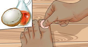 How to prevent an ingrown toenail from recurring. 3 Ways to Get Rid of Ingrown Toenails - wikiHow