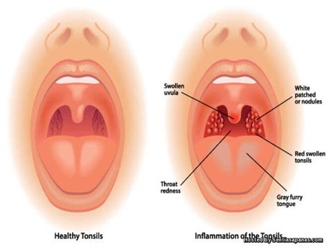 Mohon penjelasan bagaimana puasa kita yang kadang tanpa sengaja menelan air liur? Punca Tonsil Bengkak Akibat Bakteria Dan Sistem Antibodi ...