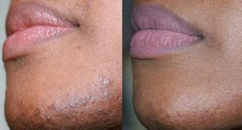 It might be caused by a medical condition that can be treated. How to Stop Female Facial Hair Growth Using Diet And ...