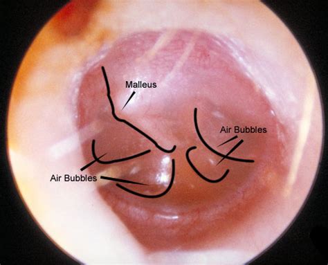 We did not find results for: Fluid in the ear Images | McGovern Medical School