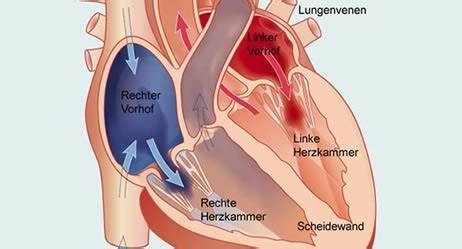 Das herz ist ein großer muskel, das im medizinischen als. Herzmuskelentzündung (Myokarditis) | Apotheken Umschau