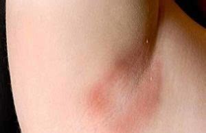 Hickeys have a reputation for adorning the necks of teenagers, but while it might be a tad unprofessional to show up to a college seminar or work meeting covered in them, let's be real: How Long Do Hickeys Last, Hickey Pictures, Definition, are ...