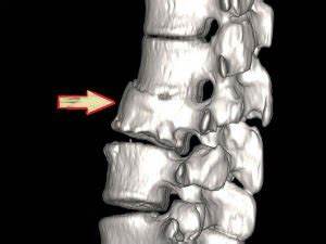 Остеофиты лечение диета Остеофиты позвоночника (шейного, грудного отдела): лечение краевых Остеофиты позвоночника (шейного, грудного отдела): лечение краевых Остеофиты лечение диета