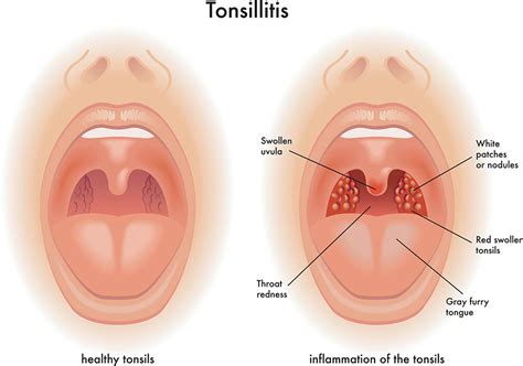 Tonsil yang mempunyai bintik putih atau kuning; AzBudi Pusat Pakar Perubatan Homeopati & Naturopati: INFO ...