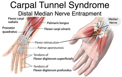 This syndrome causes numbness and pain, and can progress to a decrease in muscle and weakness of the areas innervated by the median nerve. Carpal Tunnel Syndrome - Causes, Treatment, Splint & Surgery