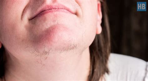 Unlike treatments that just pull the hair out (waxing this customized approach yields safer, more permanent results with fewer laser hair removal laser hair removal is a great way to permanently get rid of unwanted hair anywhere on your body. A Lowdown On How To Get Rid Of Chin Hair Permanently