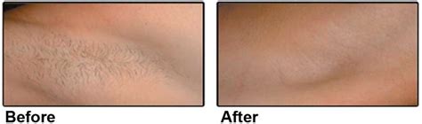 It leaves the skin looking smoother and silkier than waxing, electrolysis or razors and is a gentle technique that can treat larger areas effectively with minimal discomfort and. Laser Procedures New York City | Scar Removal | Laser Hair ...