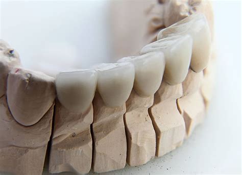 How much tooth structure is needed for a crown? Dental crown cost | How much is a tooth crown? - Porcelain ...