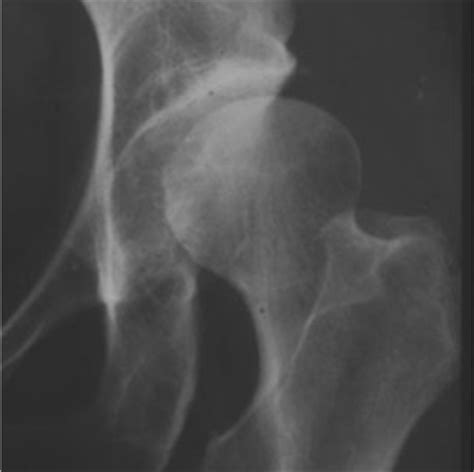 Maybe you would like to learn more about one of these? Arthritis of the Hip - Types, Symptoms, Diagnosis, Treatment