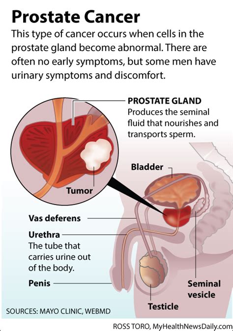 Prostate cancer is the most common cancer among men. Prostate Cancer Screening: Should You Wear the Gown?