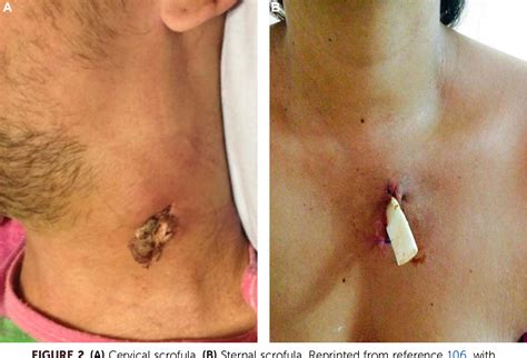 The parotid gland is the salivary gland most commonly affected by. Figure 2 from Tuberculous Lymphadenitis and Parotitis ...