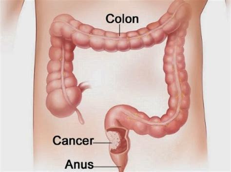 Colon cancer or colorectal cancer starts in the large intestine or in the rectum. Signs and symptoms of colon cancer in women and men | WikiYeah