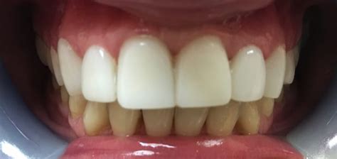 It is expensive, but less expensive than traditional braces and it. Close Gap In Front Teeth In One Visit Without Braces ...