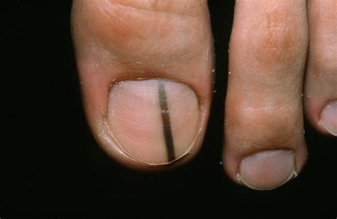 It is a common type of melanoma that arises from a benign mole. Melanomas on the feet and legs | Lindsey Ebbs Podiatry