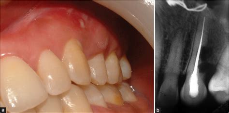 Regular brushing and flossing can help keep a painful gum abscess away. Clinical attachment level gain and bone regeneration ...