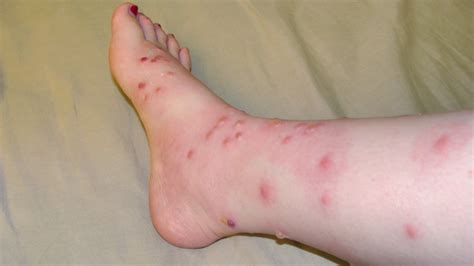 It depends on what sort of rash it is, and what treatment you are using. Poison Oak Treatment: Symptoms & 5 Natural Treatments ...
