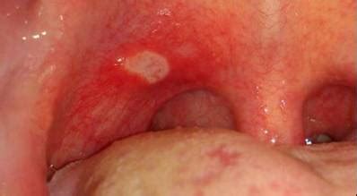 This site is usually the home of a yeast infection called angular cheilitis. Canker Sore or Mouth Sore in My Throat? | UtoDent.com