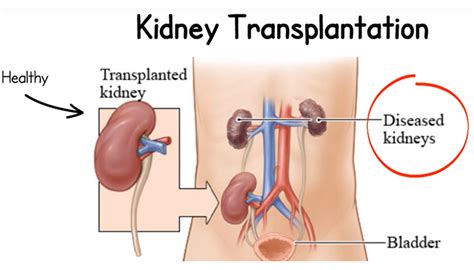 Check spelling or type a new query. Kidney Transplant Cost In India | Success Rate | Recovery