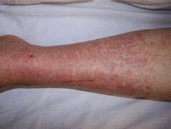 Infection causes redness of the skin. Raoultella ornithinolytica