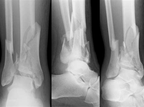 The Comprehensive Guide To Tibial Plafond Fracture Treatment
