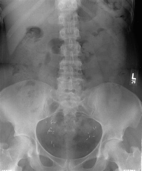 While lumbar motion is potentially greater than that of the thoracic spine because of the lack of rib restriction, the angle of facet facing and the heavy because of the restriction of normal movements in the thoracic spine and the relatively mobile lumbar spine below, the intervening thoracolumbar area. AP lumbar spine radiograph for patient #1. This film was ...