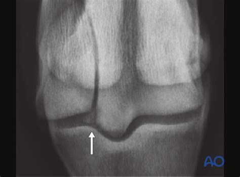 Lateral condyle displaced fractures