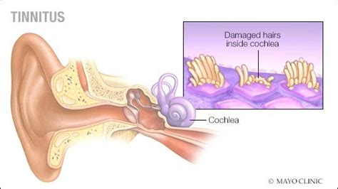 It is common and not usually a sign of anything serious. Looking for a Natural Tinnitus Treatment? Dentistry May ...