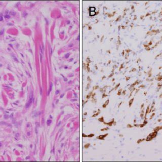 Melanoma of the small intestine stained with HMB-45 (x 100 ...