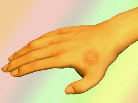 1 1 what does a black widow spider bite look like? Black Widow Spider Bite Stages
