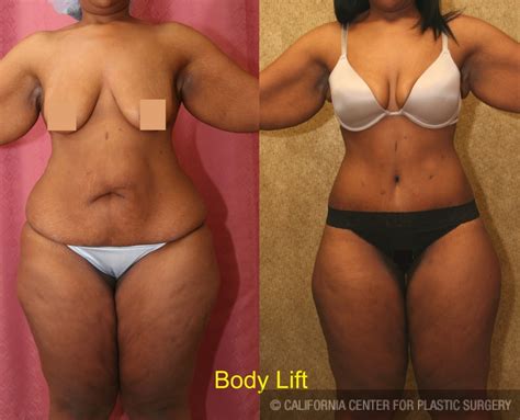 The application shows before and after photos of dr. Patient #6058 Body Contouring Before and After Photos ...