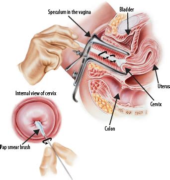 Although former guidelines recommended starting pap smear screening at age 18 or the onset of sexual activity, these guidelines were the patient should be supine, in dorsal lithotomy position to correctly perform a pap smear (see the image below). Obstetrik & Ginekologi - Klinik Hana, JB