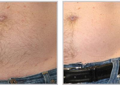 As we say in our facility hair today, gone tomorrow. Laser Hair Removal in the Woodlands | East Shore Salon and ...