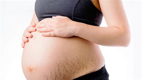 Nausea, mual mutah dan malaise. Apa itu Stretch Mark ? Definisi, Penyebab, Gejala dan ...