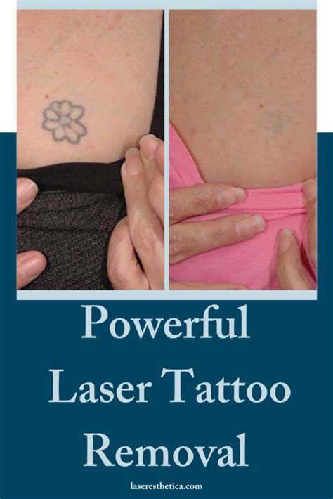 5534 elvas ave, sacramento ca 95819. Powerful Tattoo and Pigment Removal - Prasad, Nalini ...