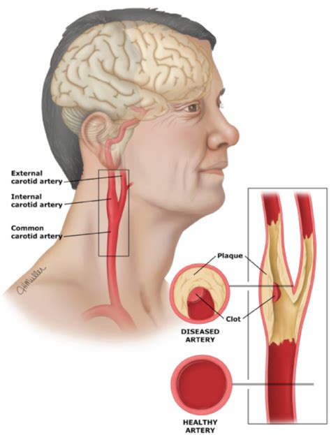 The cervical part of the internal carotid artery undergoes a straight course in the neck from its origin up to the base of skull. Carotid Artery Disease & Stroke - Victorian Vascular