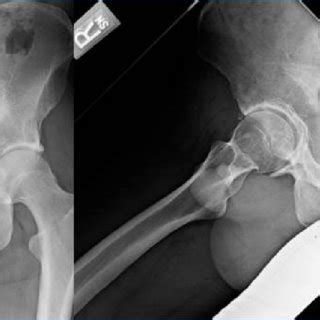Anterior Inferior Iliac Spine (AIIS) Avulsion Fracture ...