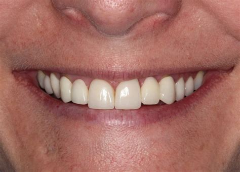 We did not find results for: Porcelain Veneers, Ash Estafan DDS, Port Smiles