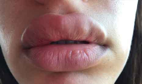 May 24, 2021 · one of the common natural winter skin problems is windburned lips. Big Lips with Juvederm Are Not Always Better Lips - Orange ...